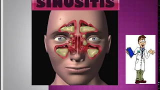 Sinusitis and its complications