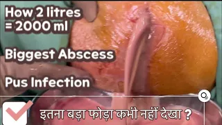 2 liters of PUS ? VERY VERY BIGGEST ABSCESS ? How surgery to drain Abscess infection ? CELLULITIS