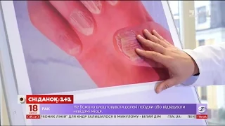 Методи лікування псоріазу - Доктор Валіхновський