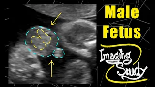 Male Fetus - Its a Boy || Ultrasound || Case 86