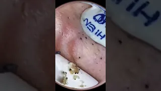 Full clean Blackhead p1#acne #squeeze #squeezeyuk #pimple #blackhead #blackheads #satisfying