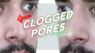 Clogged / Enlarged / Congested Pores - How To Prevent Forever! ✖  James Welsh