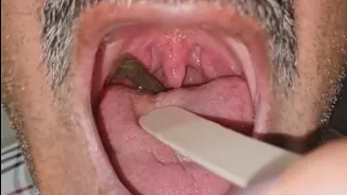 Weird case of removing a huge leech from the throat
