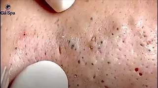 FULL SUPER BLACKHEADS 44 MINUTES