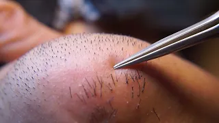 Hair removal asmr pull out with Tweezers  Satisfying pull out beard 12min 202403