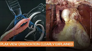 Parasternal long axis echocardiographic view anatomy: POCUS pearls - Dr. Koratala