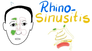 Rhinosinusitis (Acute& Chronic): Clinical Picture, Diagnosis& Management + Cases