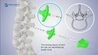 PKP Percutaneous Kyphoplasty System (PKP)