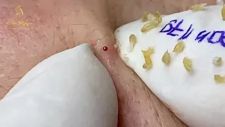 Blackheads like rice grains popped up ( 179)