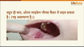 What should you know about Lichen Planus treatment Hindi- Part 2/2