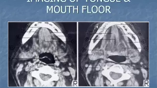 Imaging of the tongue & mouth floor   Dr Ayman Ismail