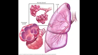 إزاى تقرا الاشعه المقطعية على الصدر CHEST EMPHYSEMA