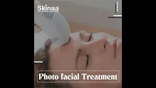 Photo Facial Treatment at Skinaa Clinic | Viral #shorts