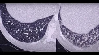 Lymphagitic carcinomatosis progress in 2 months - CT findings