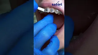 Стрипинг зубов с брекетами