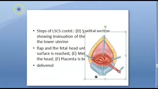 Obstetrics 693 b Prepare for Cesarean CSection Operation Surgery Patient Step PreOperative Mendelson