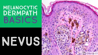 Melanocytic Dermpath Basics: Benign Nevus