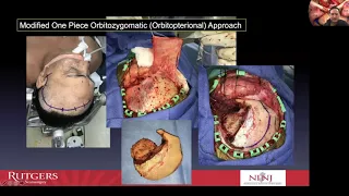 Unlocking the Cavernous Sinus by James K. Liu M.D. / Curso de Base de Craneo Dr Diego Mendez Rosito