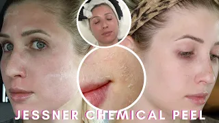 My CHEMICAL PEEL Experience // JESSNER Chemical PEEL