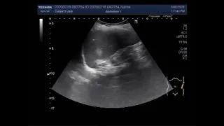 Ultrasound Video showing a metastasis in spleen.