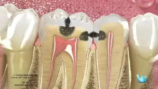 Caries y restauración dental