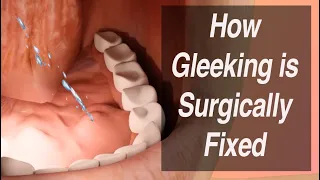 How Gleeking is Surgically Corrected