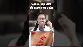 Cách Phân Biệt Bệnh Lý Zona Và Viêm Da Tiếp Xúc Do Côn Trùng | Dr Huỳnh Trang #short