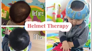 12 Weeks Progress: Helmet Therapy For Flat Head Syndrome/Plagiocephaly