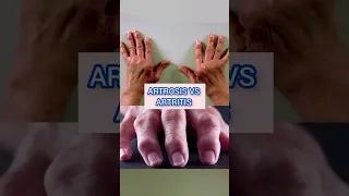 ARTROSIS  VS ARTRITIS