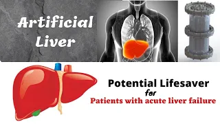 Artificial LIVER. Lifesaver -patients with acute liver failure /Biology Hemodialysis/Charcoal filter