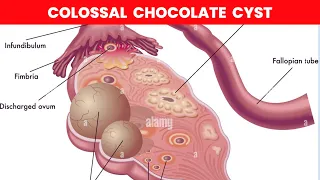 Colossal Chocolate Cyst | Dr Kunal Rathod