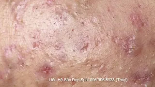 Acne | Điều Trị Mụn Tuổi Dậy Thì - SacDepSpa#330