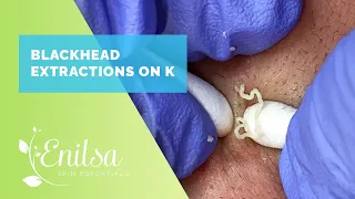 Blackhead Extractions on K - Sept 2022