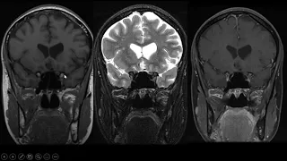 Imaging of Skull base lesions