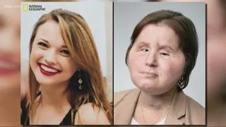Face transplant recipient gets second chance after failed suicide attempt