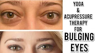Eye Exercises & Accupressure Therapy for Bulging Eyes or protruding eyeballs due to Hyperthyroidism
