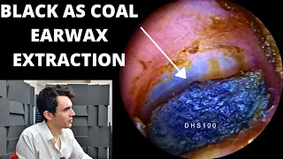 Black As Coal Ear Wax (Extracted With Oil And Suction)