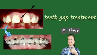 teeth gap treatment | Braces