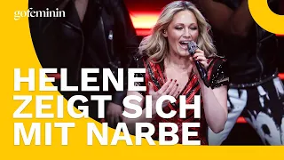 Helene Fischer: Fotos zeigen Narbe nach ihrem Unfall