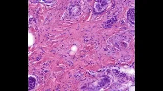 Solid variant of microcystic adnexal carcinoma Phillip McKee Antonina Kalmykova CSD Health Care