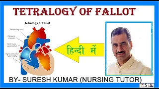 TETRALOGY OF FALLOT  - HINDI