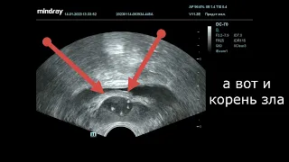 УЗИ в урологии. Опухоль семенного пузырька