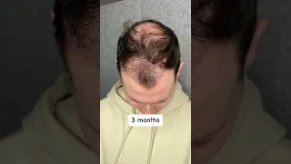 Haartransplantation Verlauf