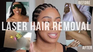 Laser Hair Removal: Things To Know + Before & After | zoerudd