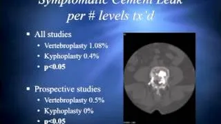 Vertebroplasty Revisited