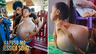 Bata mula Zamboanga del Sur, aabot ng 15 kilos ang bigat ng lumobong tiyan | Kapuso Mo, Jessica Soho