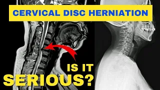 Is A Cervical Disc Herniation Serious? | Dr. Walter Salubro Chiropractor in Vaughan