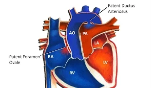 Transposition of the Great Arteries