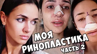 РИНОСЕПТОПЛАСТИКА и ТУРБИНОПЛАСТИКА - 👃 НОВЫЙ НОС / Это жесть....