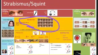 Ophthalmology 352 Strabismus Squint INTRODUCTION CLASSIFICATION Difference Heterotropia Heterophoria